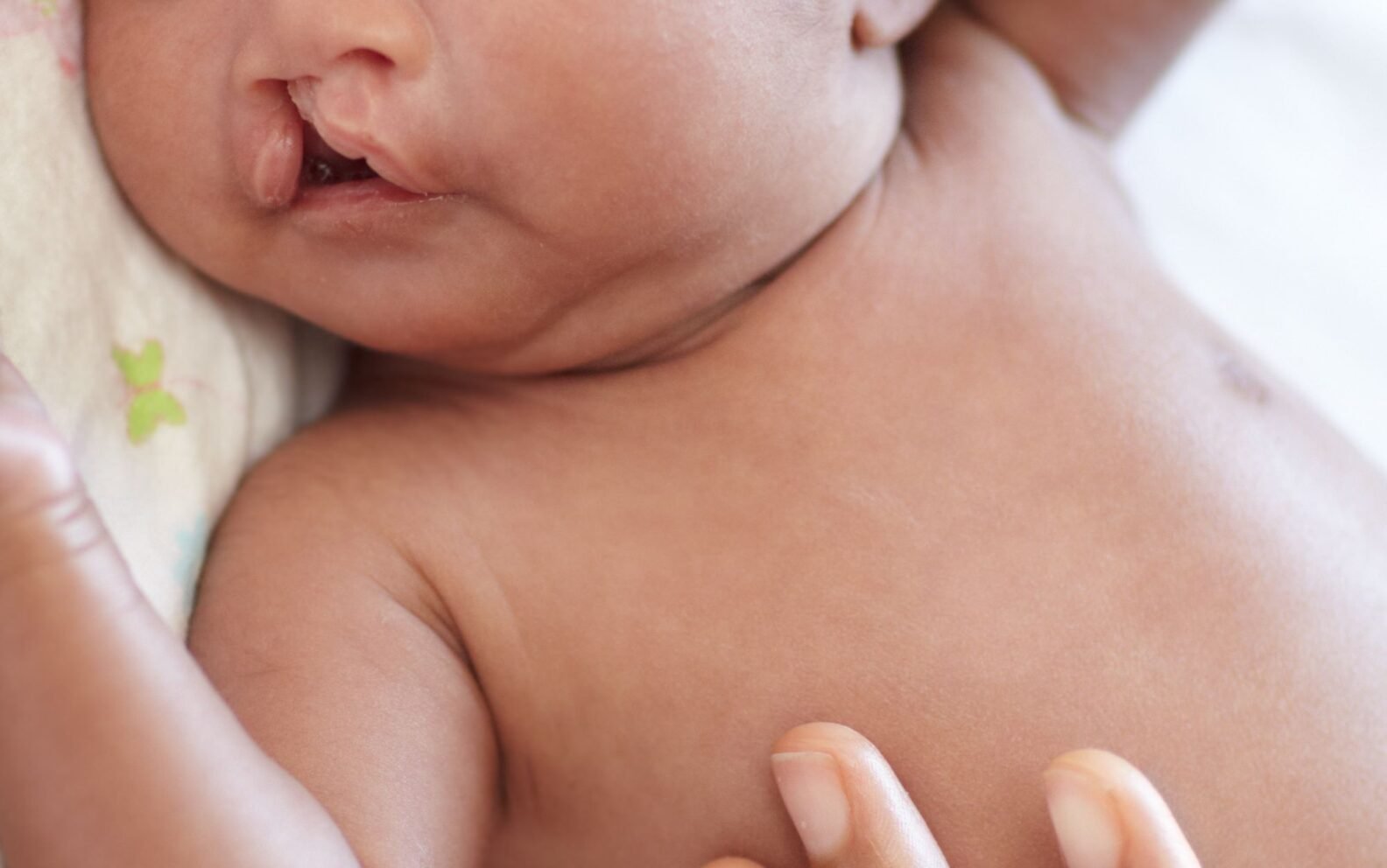 Bebé con fisura labiopalatina en tratamiento especializado